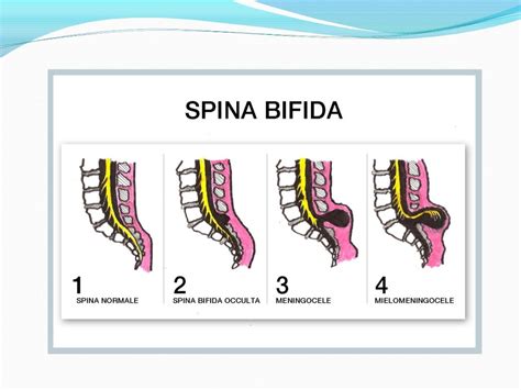 icd q05 spina bifida